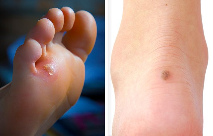 Tirar calo no pé: qual o melhor jeito? Podólogo dá dicas valiosas