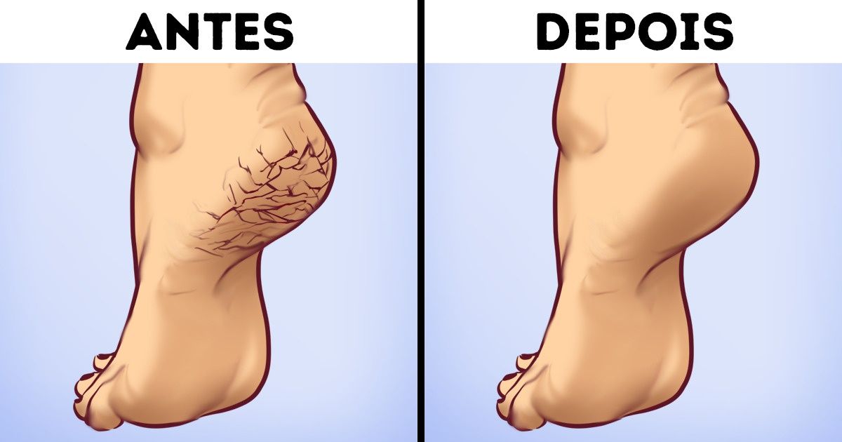 Tirar calo no pé: qual o melhor jeito? Podólogo dá dicas valiosas