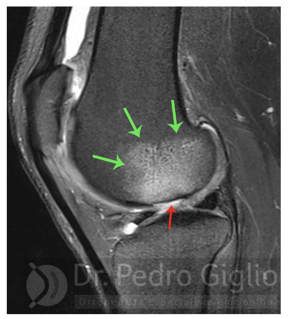 Edema ósseo: o que é, causas e tratamentos (Guia Completo)