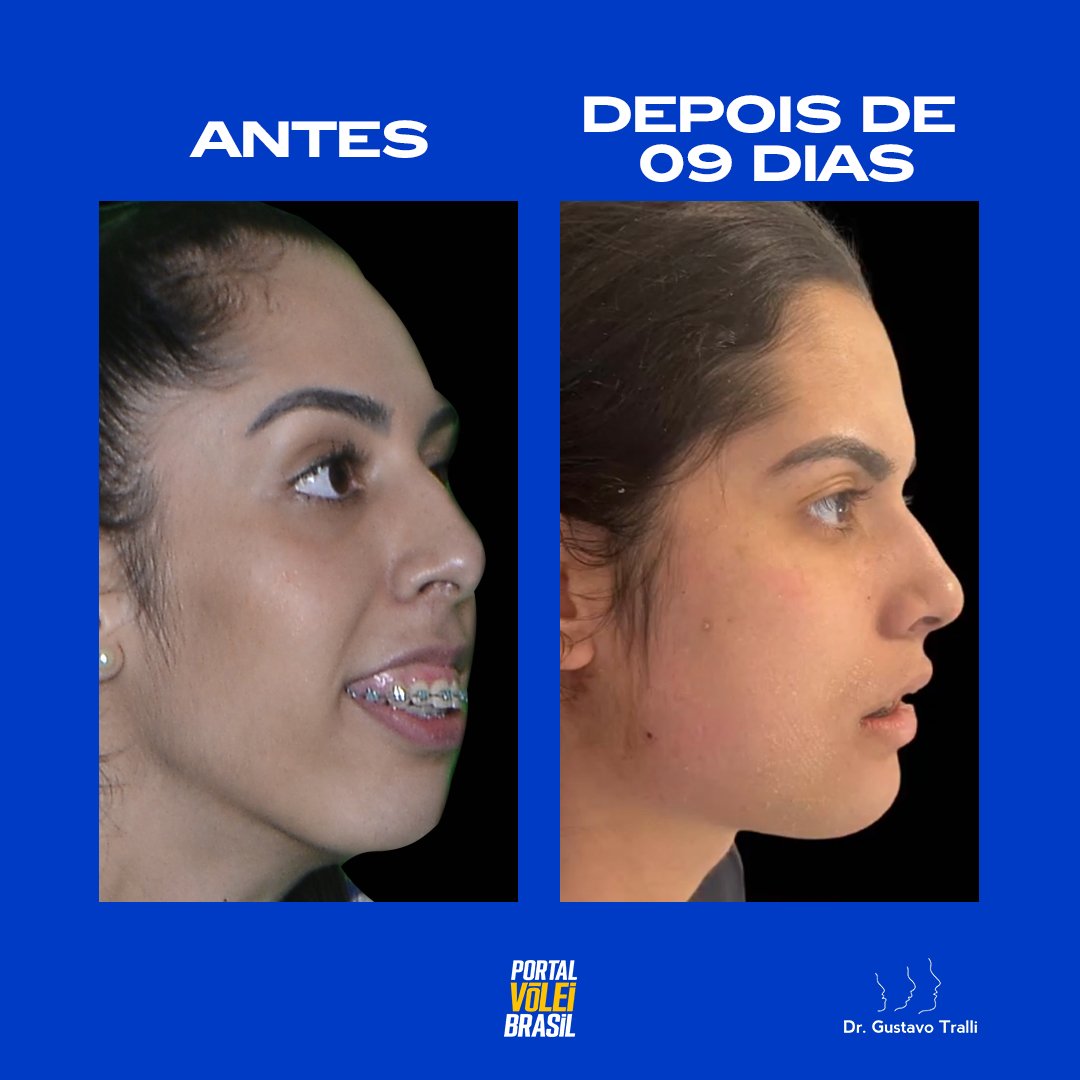 Diana Vôlei Antes e Depois da Cirurgia: Veja a Transformação!