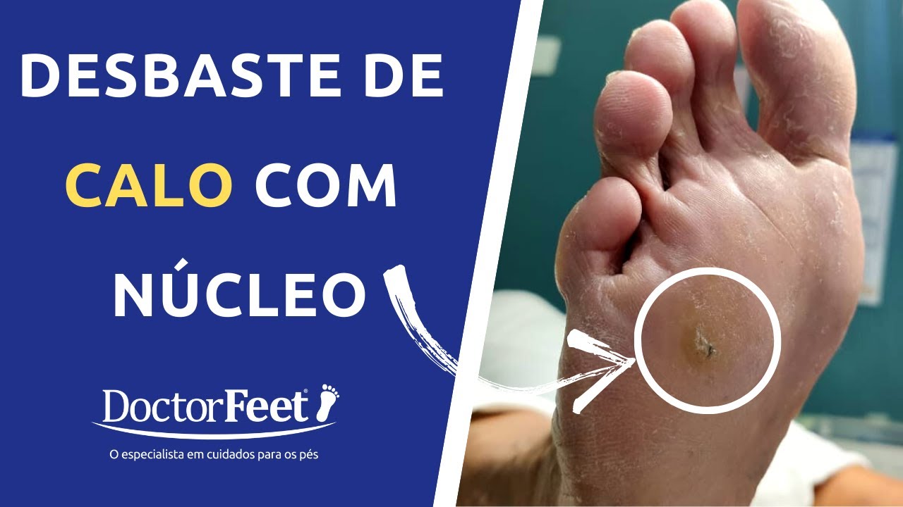 Tirar calo no pe (bem fácil)
