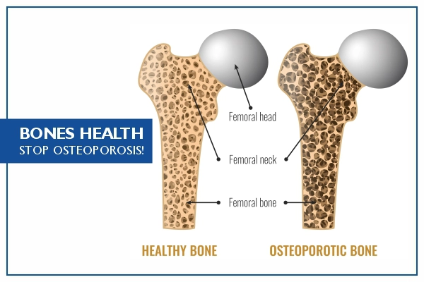Osteopenia: sintomas? (Aprenda a notar!)