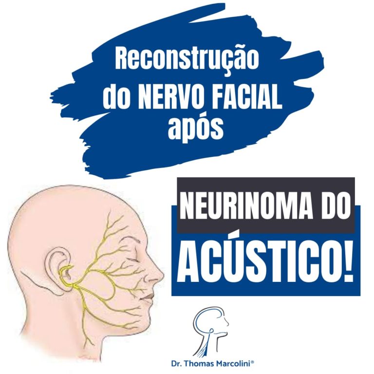 Neurinoma do acustico depoimentos reais saiba como foi minha experiencia