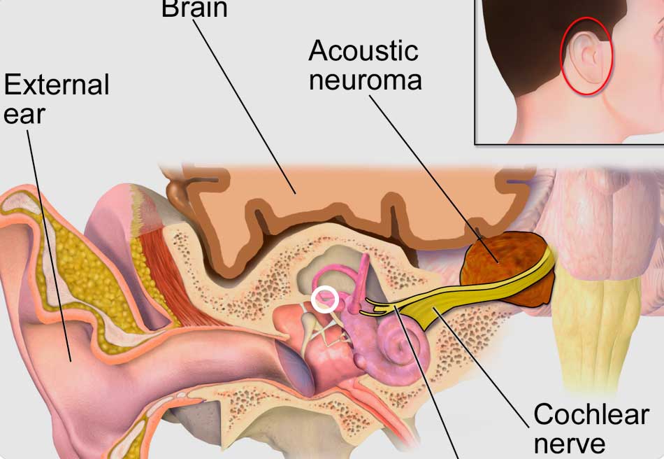 Neurinoma do acustico depoimentos reais saiba como foi minha experiencia